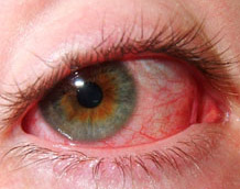 Allergic conjunctivitis steroid eye drops
